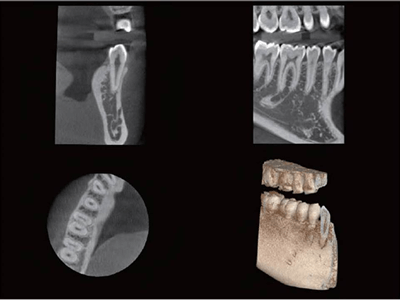 歯科用３D－CT