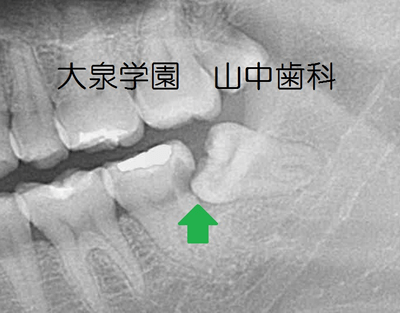 部分床義歯