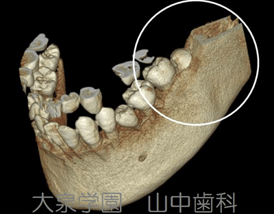 全部床義歯